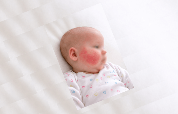 Projevy potravinové alergie